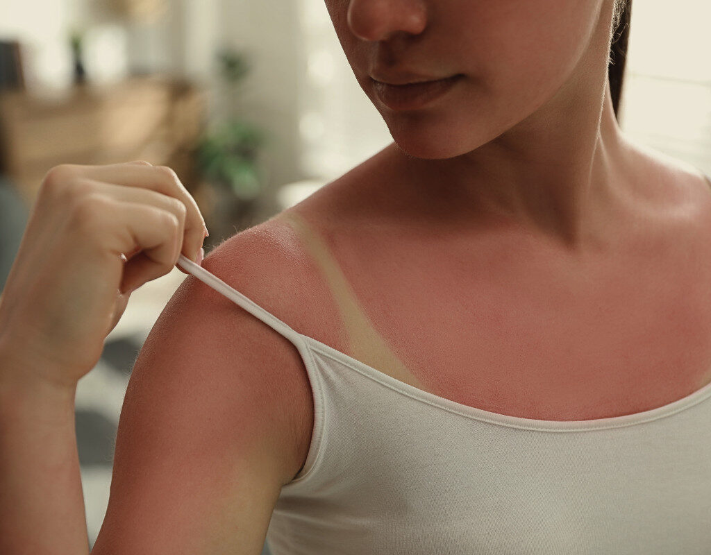 Sunburn Relief in Bali: Cooling Spa Treatments for Overexposed Skin by My Bali Healing